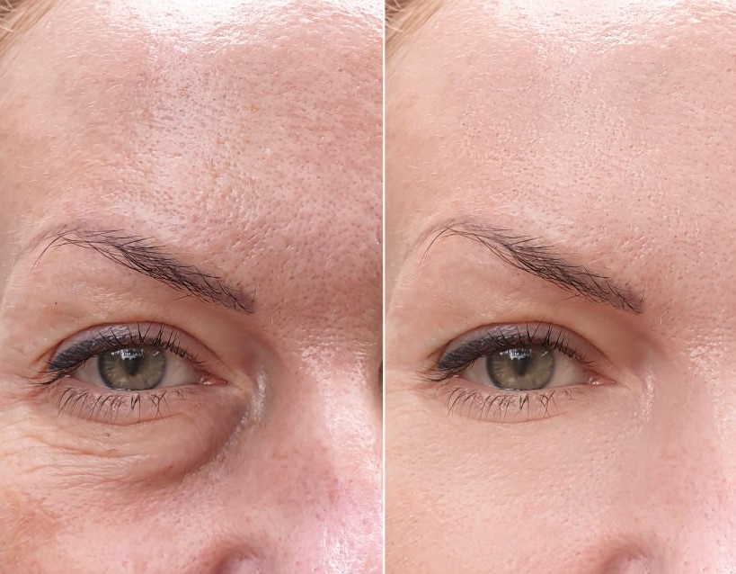 Refined contour results